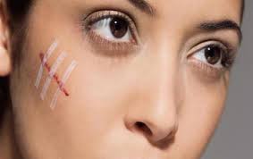 دیه جراحات سر و صورت